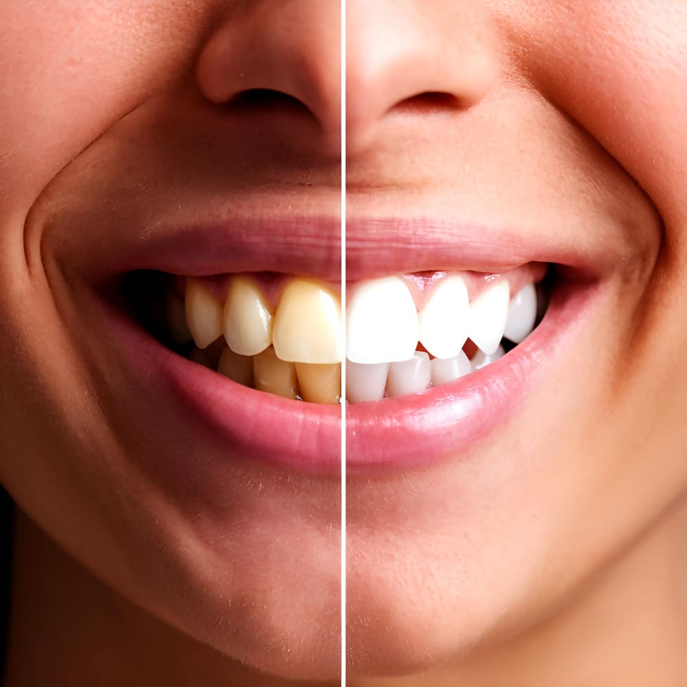 Blanqueamiento Dental